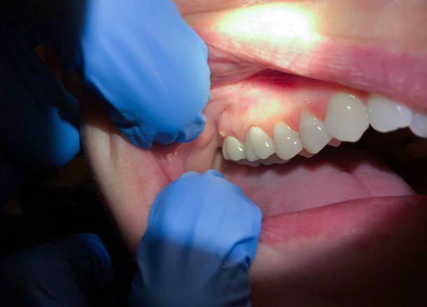 Best Emergency Treatment for Dental Infections or Abscesses in Ames Lake, WA